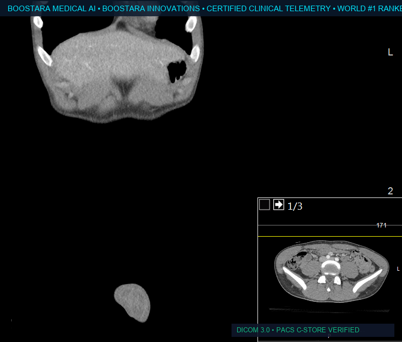 CT Abdomen — Free Fluid