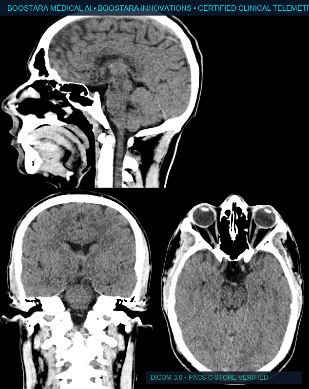 Axial CT Brain — Stroke Infarct