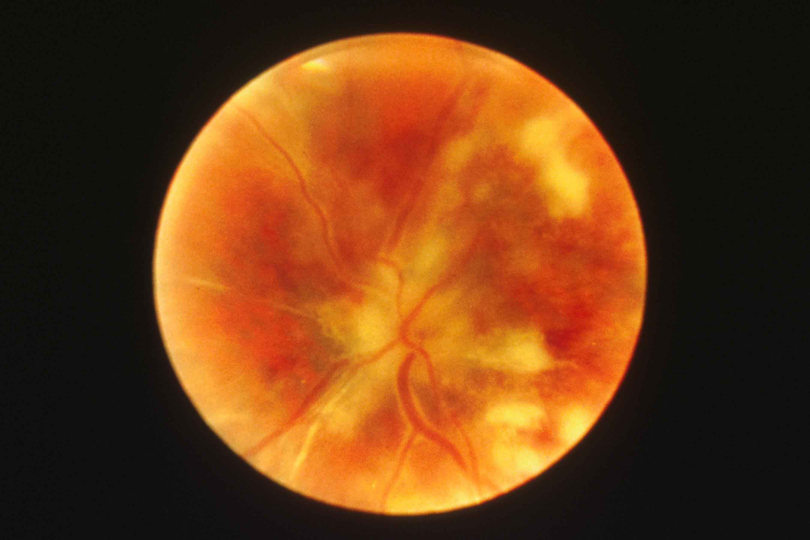 Fundus Retinal Photograph — Diabetic Retinopathy AI Analysis
