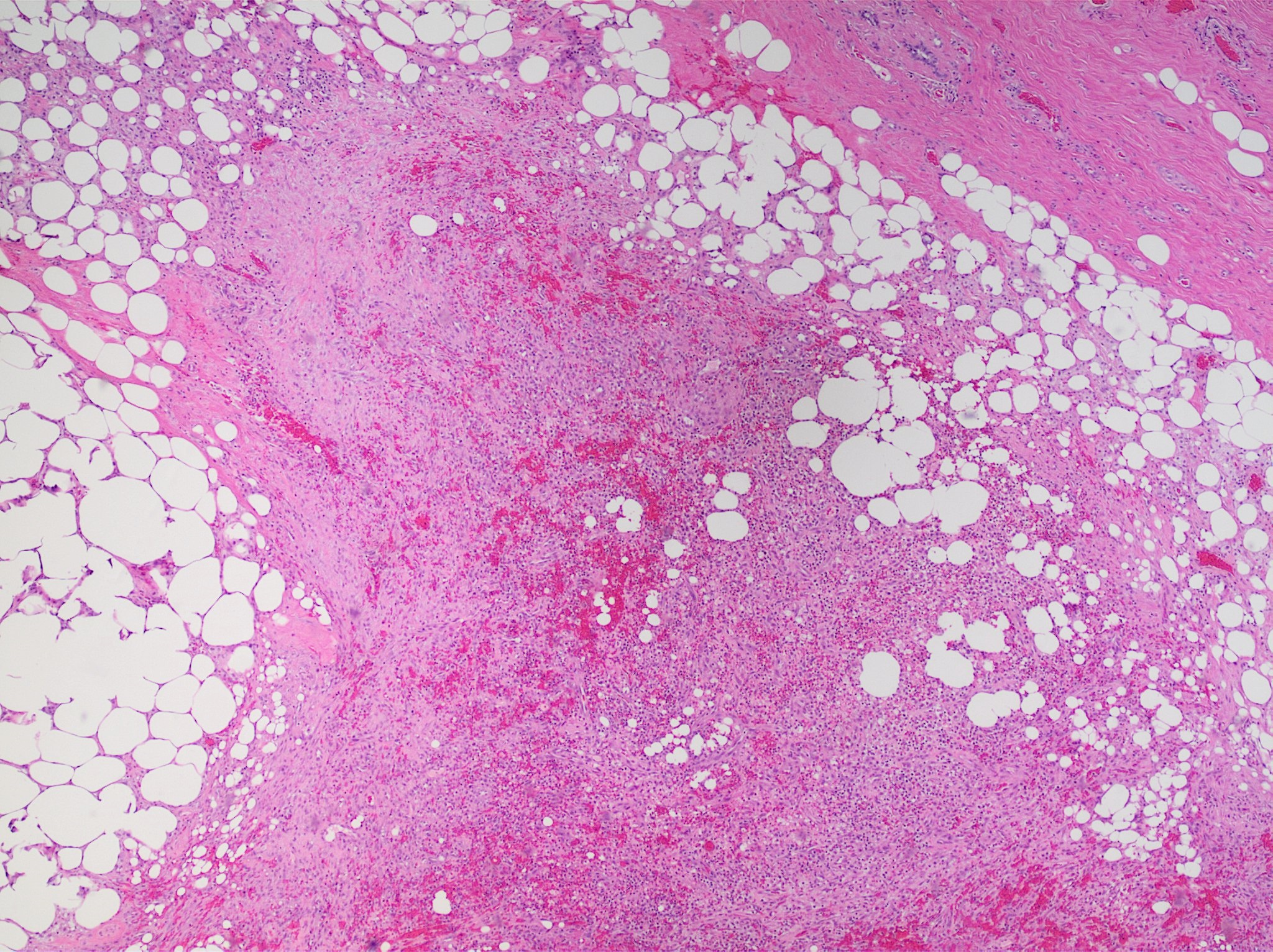 H&E Whole-Slide Histopathology — Invasive Carcinoma