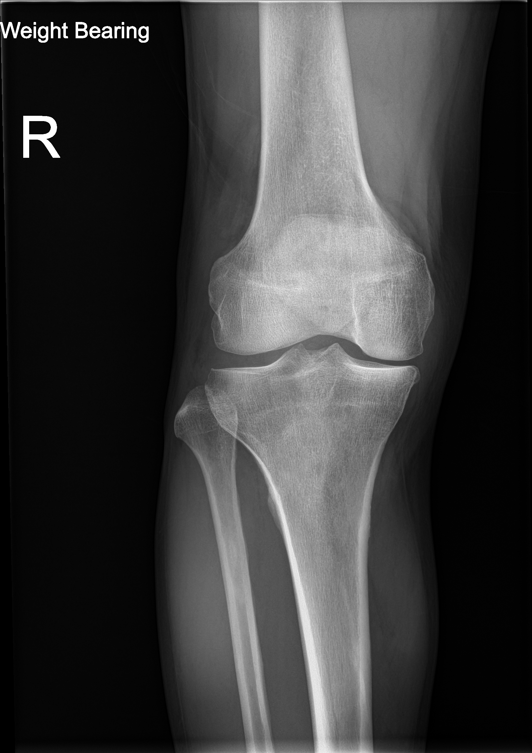 Knee Radiograph — Orthopedic AI Analysis