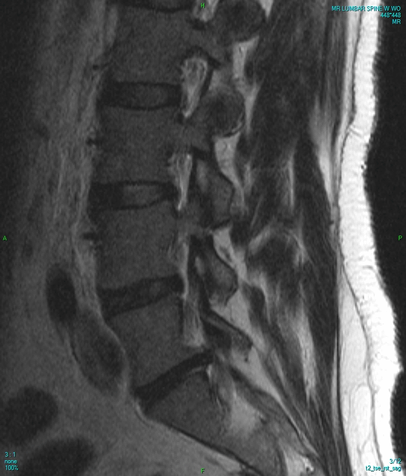 Animated MRI Spine — Sagittal Sequence