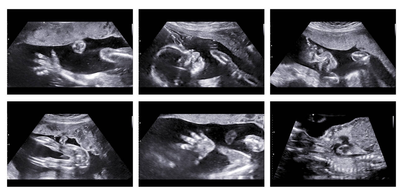 POCUS Point-of-Care Ultrasound Scan