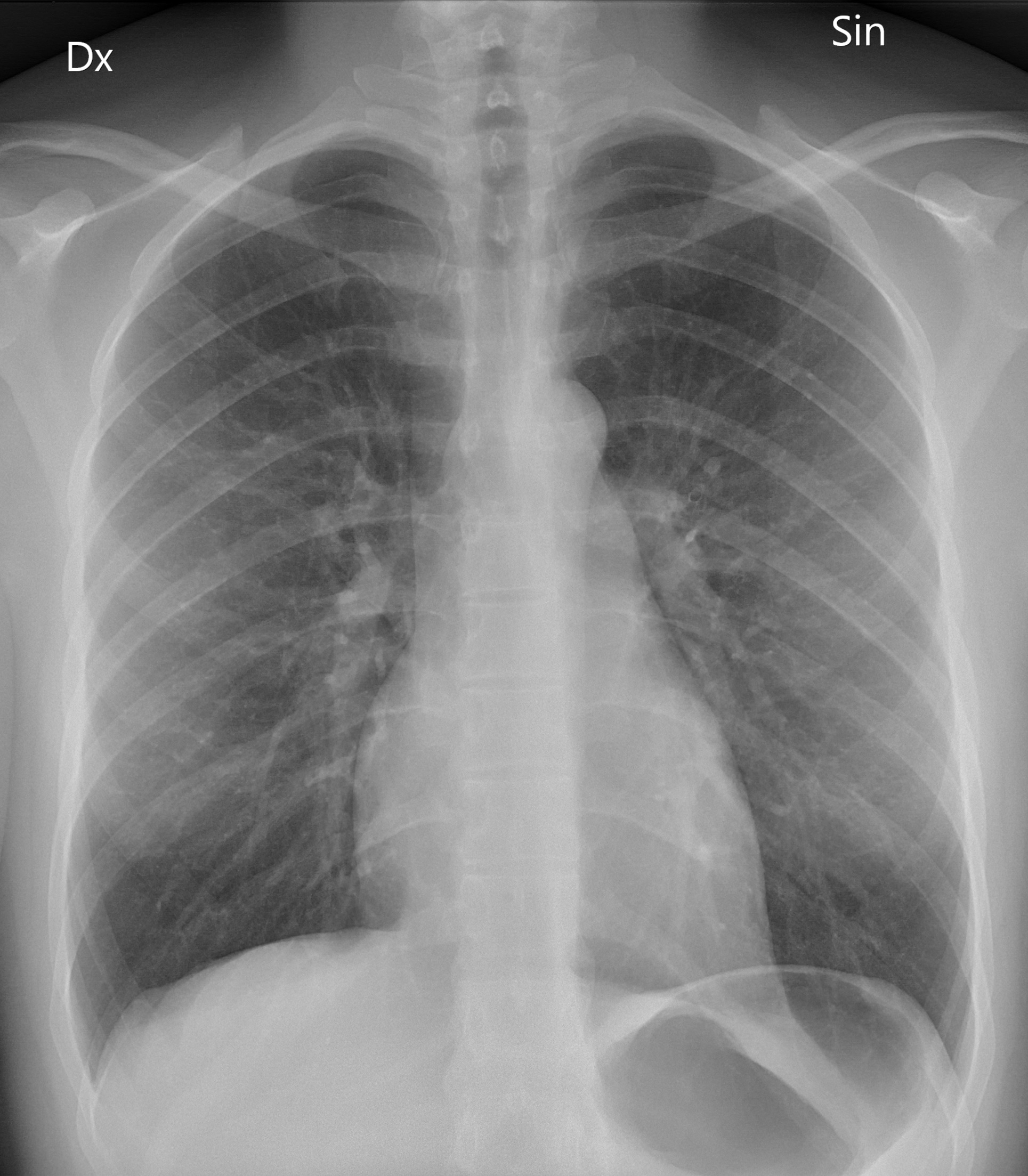 Clinical Chest Radiograph — AI analysis by Boostara
